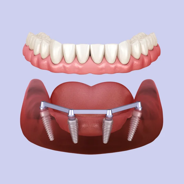 Illustration of dental implants replacing missing teeth