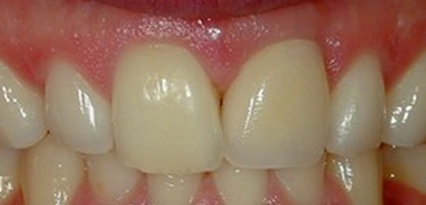 Front teeth after dental implant treatment replacing a missing tooth.