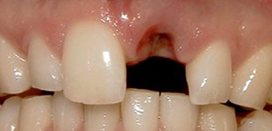 Front teeth before dental implant treatment with a missing tooth.