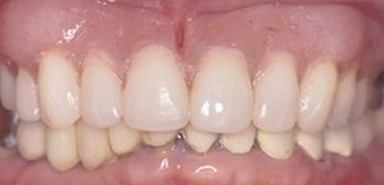Teeth after dentures or partial denture treatment.