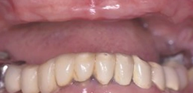 Teeth before dentures or partial denture treatment.