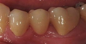 Fixed dental bridge after treatment