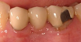 Fixed dental bridge before treatment
