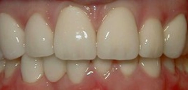 Front teeth after porcelain crown treatment.