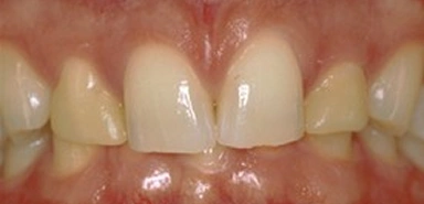 Front teeth before porcelain crown treatment.