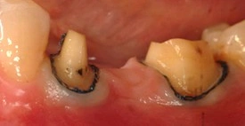 Porcelain fixed bridge before treatment