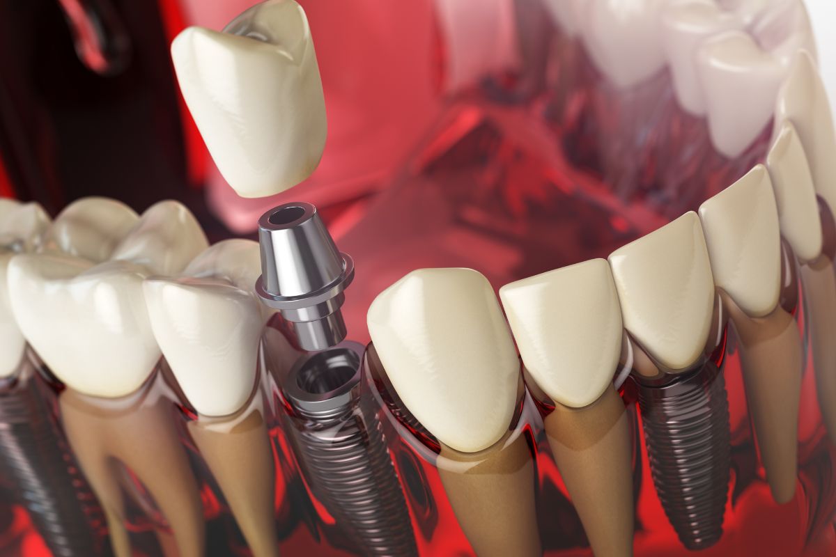 The Risks of Waiting Too Long for a Dental Implant